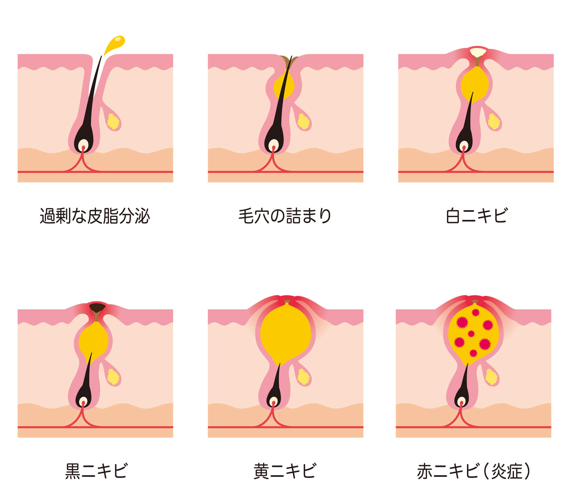 意外と厄介 眉に出来るニキビの原因と対処法を徹底解説 B Glenish ビーグレンイッシュ スキンケア化粧品 サイエンスコスメのビーグレン