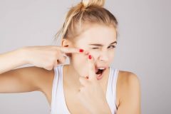 黄ニキビを潰して治すのは間違い!?黄ニキビの原因とケア方法を解説
