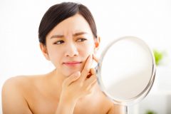 こめかみやフェイスラインニキビの原因と対策!ニキビ跡にもなりやすい?