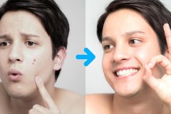 男性のニキビと吹き出物って何が違う?保湿や化粧品で対策できるの?