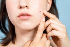 化粧水が合わないとニキビや肌荒れに!?パッチテストのやり方を紹介