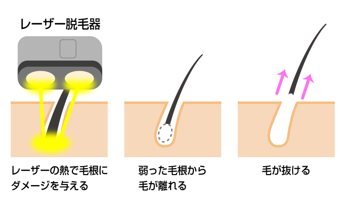 医療レーザー脱毛の仕組み