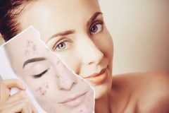 炎症性色素沈着の治療法と薬の種類を紹介!セルフケアで治す方法は?